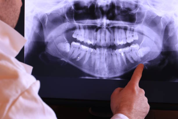 Emergency Dentist for Dental Implants